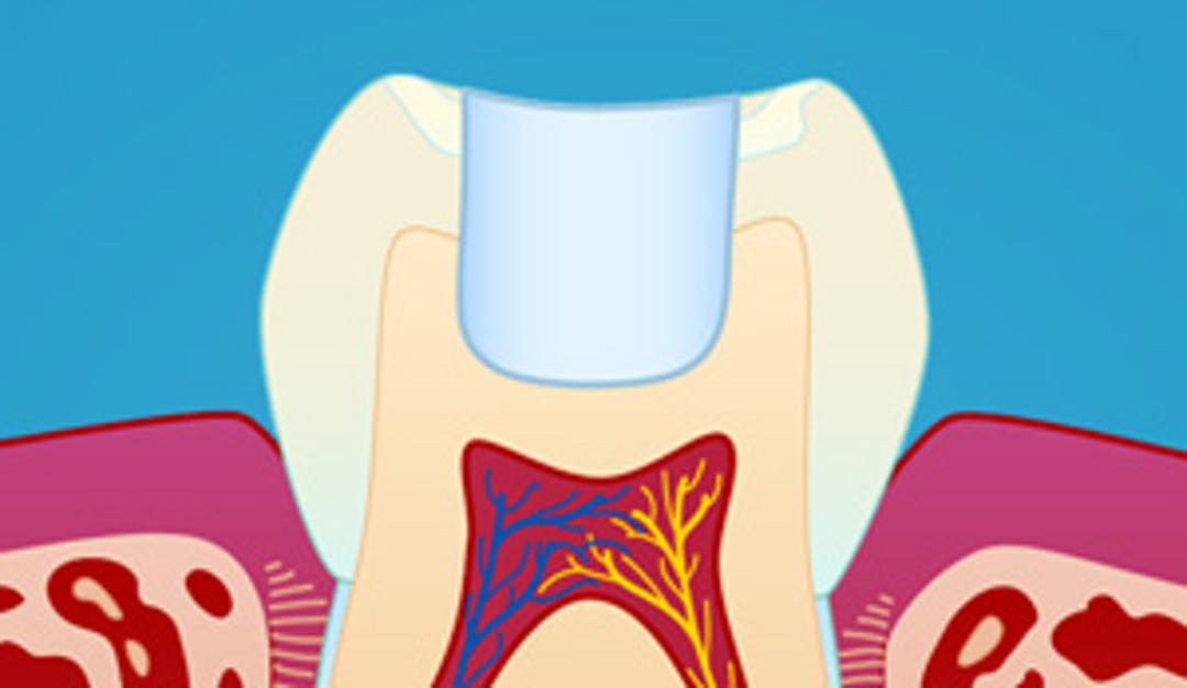 Fyllingsterapi__w300__f9f8ea6f8e00a948b18f74624b8d6db4