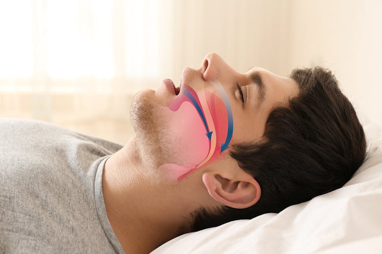 Snore problem concept. Illustration of obstructive sleep apnea